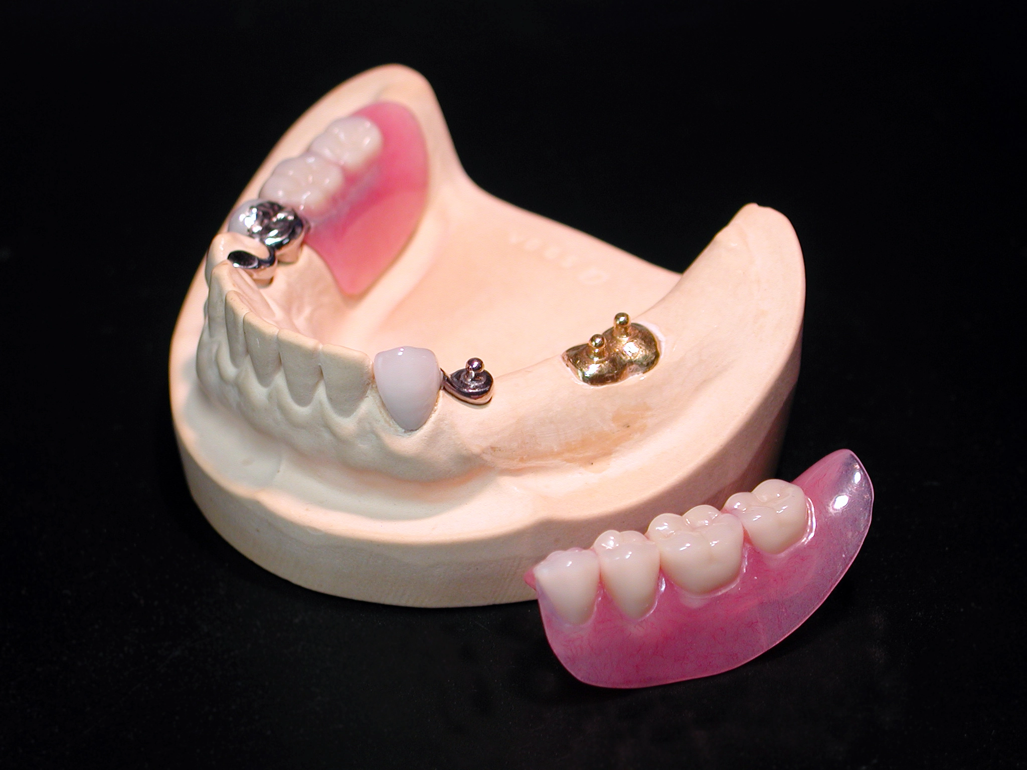 アタッチメント義歯