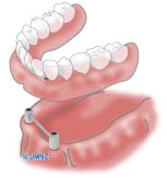 インプラントオーバーデンチャー