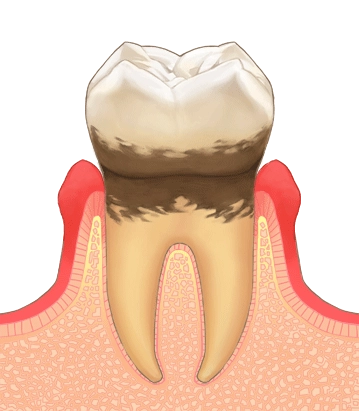 歯周炎（軽度）