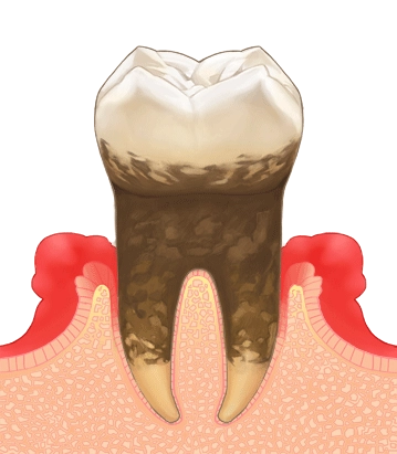 歯周炎（中度）
