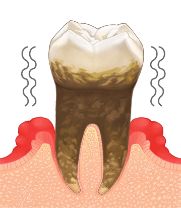 歯周炎（重度）