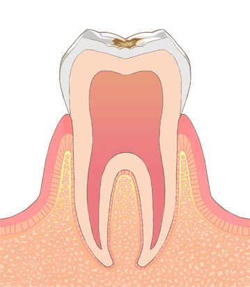 軽度の虫歯