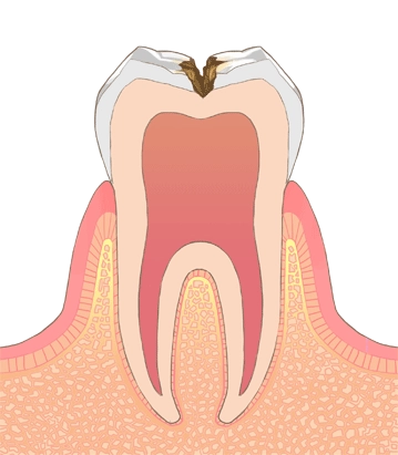 中度の虫歯